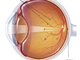 التنكس البقعي المسبب للعمى مرتبط بالعمر والنظام الغذائي