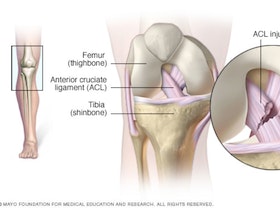 مخاطر وأعراض تراكم السوائل حول مفصل الركبة