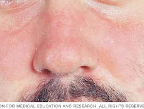 من أعراضه الحكة والجفاف.. ماذا تعرف عن التهاب الجلد وأنواعه؟ 
