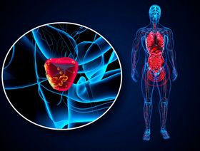 باحثون يبتكرون طريقة جديدة لعلاج سرطان البروستاتا العدواني