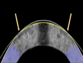 بديل لعمليات الليزك.. تصحيح الإبصار بالتيار الكهربائي