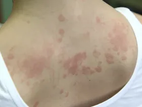 حساسية الدواء.. نصائح للحد من تفاعل مناعي يهدد جسم الإنسان