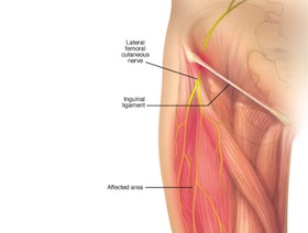 ألم الفخذ المذلي.. الأسباب وطرق العلاج