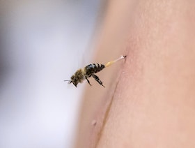 متى يجب علاج لسعات النحل؟