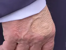 ترمب: أتناول جرعة أسبرين أكبر لأنه مفيد "لتخفيف الدم"