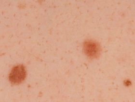 نوع نادر من سرطان الجلد.. ما هي الخلايا اللمفاوية التائية؟