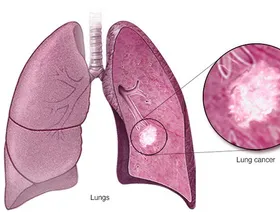 علاج مناعي جديد يغير مسار علاج سرطان الرئة.. شاهد التفاصيل