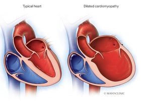 الثقبة البيضوية الواضحة في القلب.. الأسباب والأعراض والعلاج