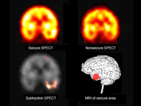 دراسة: مرضى الصرع في إنجلترا لا يحصلون على رعاية متساوية