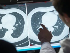 تطوير علاج للسرطان يهاجم البروتينات المسببة للمرض بدقة
