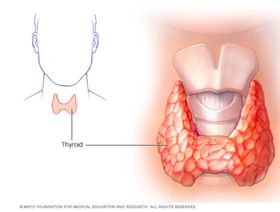 أعراض تضخم الغدة الدرقية وخيارات العلاج