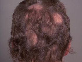 تساقط الشعر.. دليل الرجال والنساء للعلاج والوقاية