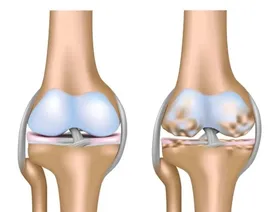 طريقة جديدة لعلاج آلام الركبة الشائعة