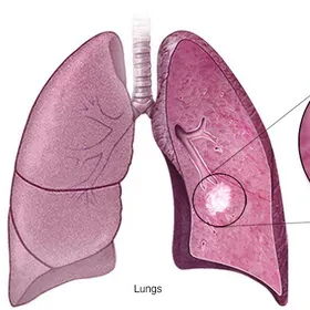 علاج مناعي جديد يغير مسار علاج سرطان الرئة.. شاهد التفاصيل
