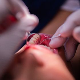 خراج الأسنان.. 7 نصائح للوقاية من الألم الخطير