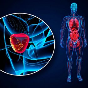 باحثون يبتكرون طريقة جديدة لعلاج سرطان البروستاتا العدواني