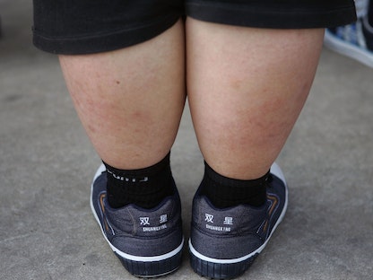 طفل يعاني السمنة خلال مشاركته في تجمع صيفي لخسارة الوزن - Getty Images