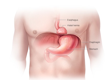 صورة توضيحية للمعدة والحجاب الحاجز - Mayo Clinic