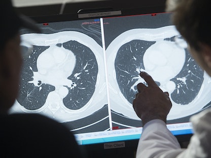 طبيب أميركي يشرح لمتعافٍ من السرطان الفرق بين صورتي أشعة تظهر الأورام السرطانية قبل وبعد العلاج - 8 فبراير 2018 - AFP