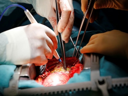 فريق طبي يجري جراحة قلبية في مستشفى بمدينة بوردو الفرنسية. 25 أكتوبر 2018 - REUTERS