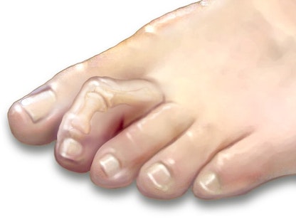 صورة تظهر الانحناء في ثاني إصبع من القدم وهي حالة "إصبع القدم المطرقية" - مايو كلينيك