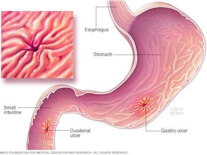 قرحة معوية بسبب بكتيريا الملوية البوابية - مايو كلينيك