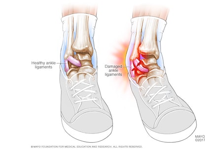 التواء الكاحل هو شد في أربطته أو تمزقها ما يؤثر على دعم المفصل. - مايو كلينيك