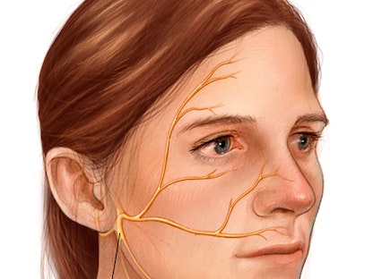 صورة توضيحية لعصب الوجه الذي قد يتضرر جراء متلازمة رامزي هانت - مايو كلينيك