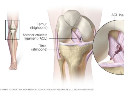 صورة توضح إصابة الرباط الصليبي الأمامي الذي يعد من الأربطة الرئيسية التي تساعد على استقرار مفصل الركبة - Mayo Clinic