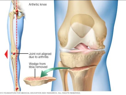  يؤدي التهاب المفاصل إلى تلف جانب واحد من الركبة أكثر من الجانب الآخر وقد يُسبب ذلك انحناء ركبتك للداخل أو الخارج - Mayo Clinic