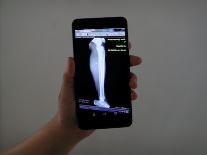 صورة أشعة لساق شخص في تشيلي. 6 نوفمبر 2019 - REUTERS
