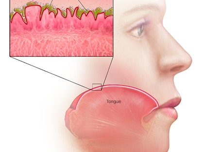 تكاثر البكتيريا على اللسان من أبرز الأسباب التي تؤدي إلى الرائحة الكريهة مع جفاف الفم - Mayo clinic