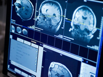 تصوير بتقنية الرنين المغناطيسي يظهر الدماغ من مختلف الجهات - Mayo Clinic