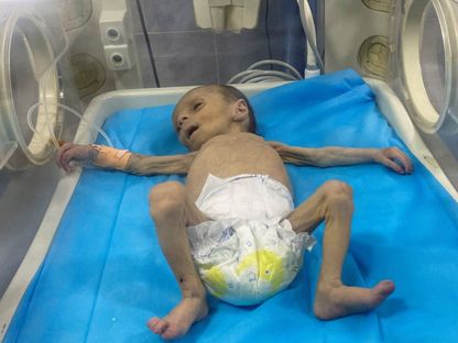 الطفلة الفلسطينية ليلى جنيد تعاني سوء التغذية الحاد وتتلقى العلاج في مستشفى كمال عدوان شمال قطاع غزة. 26 مارس 2024 - Reuters