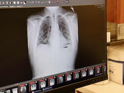 صورة أشعة لمريض تم زراعة رئتين جديدتين له بعد استئصال رئتيه الأصليتين في شيكاغو بالولايات المتحدة الأميركية 12 يناير 2022 - AFP