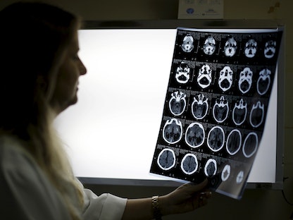 صورة أشعة لدماغ طفل في البرازيل. 27 يناير 2016 - REUTERS