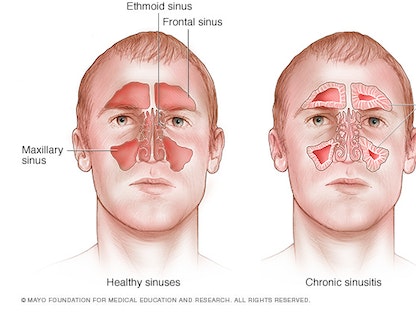 صورة توضيحية تُظهر التجويف الأنفي للإنسان. - Mayo Clinic