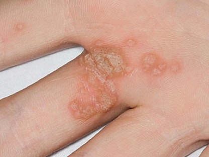 الثآليل الشائعة قد تظهر على اليدين أو الأصابع وهي عبارة عن نتوءات صغيرة محببة خشنة الملمس - mayoclinic.org