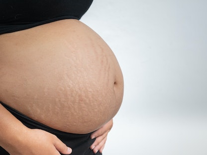 امرأة حامل وتظهر على بطنها علامات تمدد الجلد. - Getty Images