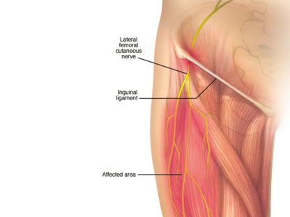 ألم الفخذ المذلي يحدث عند انضغاط العصب الجلدي الفخذي الوحشي الذي يغذي إحساس الجزء الخارجي للفخذ - Mayo clinic
