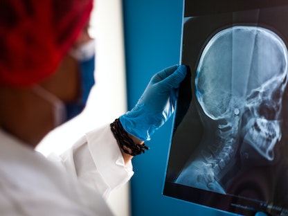 طبيبة تنظر إلى صورة أشعة بانورامية لفك وأسنان طفل، باريس، فرنسا. 1 يوليو 2022 - Maeva Destombes