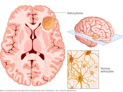 رسم توضيحي للورم النجمي داخل الدماغ - مايو كلينيك