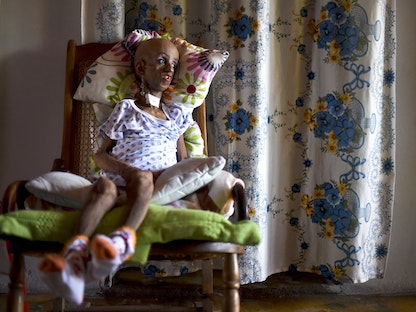 طفلة من كولومبيا تعاني "شيخوخة مبكرة" - AFP