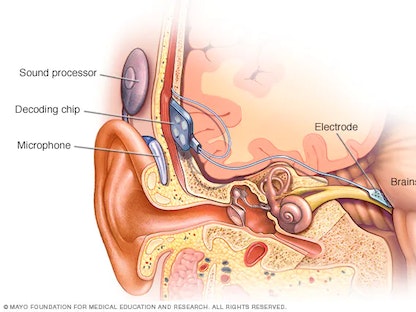 تشتمل غرسات جذع الدماغ السمعي على ثلاثة أجزاء رئيسية هي الميكروفون ومعالج الصوت الموضوعان خلف الأذن بالإضافة إلى شريحة فك التشفير الموضوعة تحت الجلد والمسارات الكهربائية المتصلة مباشرة بجذع الدماغ. - mayoclinic.org