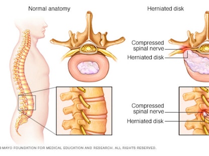 صورة توضيحية لإصابة الفقرات بالقرص المنفتق - Mayo Clinic