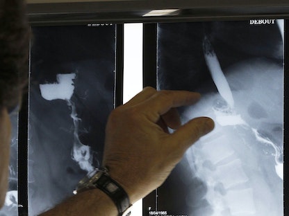 طبيب يفحص الأشعة السينية التي تظهر حلقة المعدة لأحد المرضى في مستشفى سانت جان دانجلي ببريطانيا. 25 يناير 2013 - REUTERS