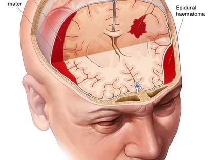 رسم يوضح وجود تجمع دموي داخل المخ وفوق الجافية نتيجة إصابة الدماغ الرضحية جراء صدمة أو هزة عنيفة يتعرض لها الرأس - uq.edu.au