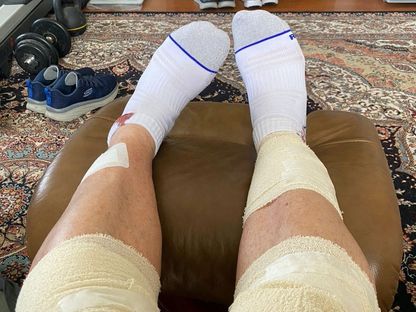 صورة أرشيفية لشاب بريطاني يعاني من تورم في ساقيه - REUTERS