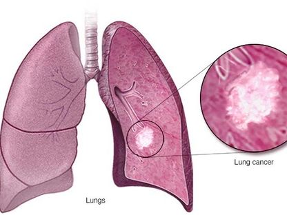 صورة تعبيرية توضح بدء انتشار سرطان الرئة من خلايا الرئتين - mayoclinic