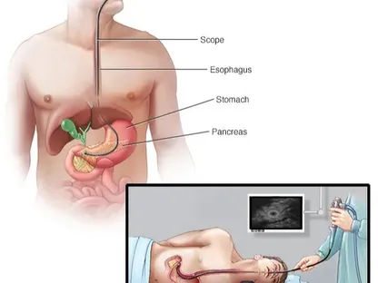 دراسة تكشف عن دور "خفي" للأعصاب في تطور مرض سرطان البنكرياس